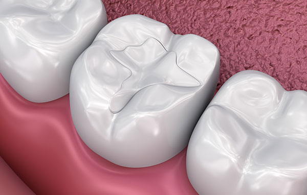 composite dental fillings; composite fillings