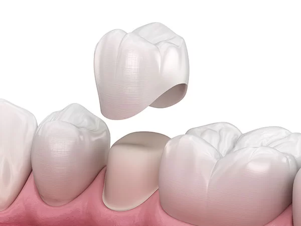 dental crown, cap, tooth crown, dental crowns